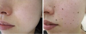 плоские родинки на лице - до и после удаления